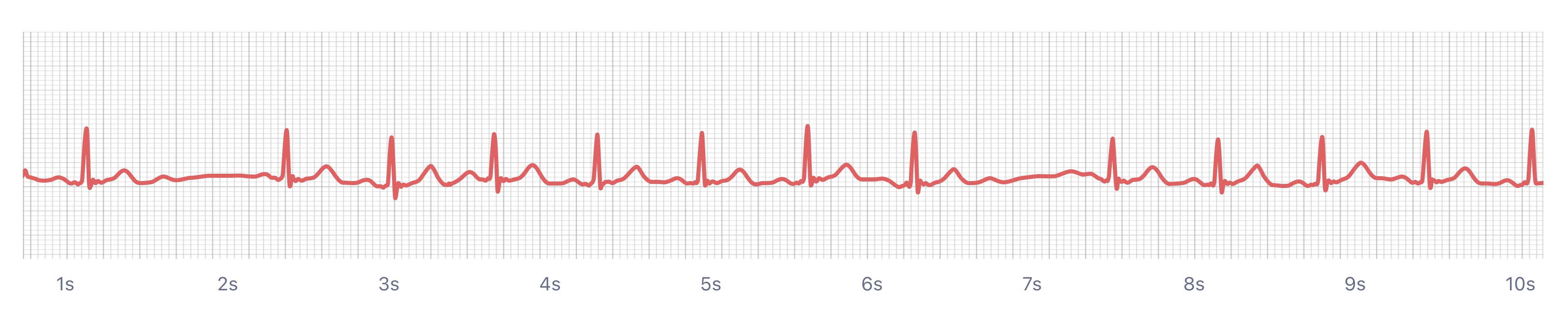 What SecondDegree AV Block Type 2 Looks Like on Your Watch ECG Qaly